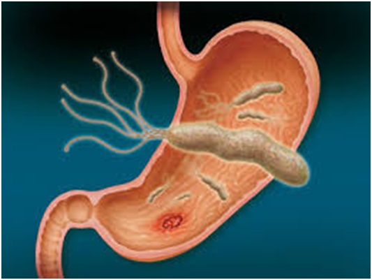 h pylori
